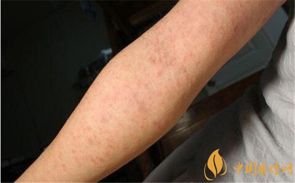 戒烟药畅沛副作用有哪些 戒烟药畅沛对人体的危害(有自杀风险)